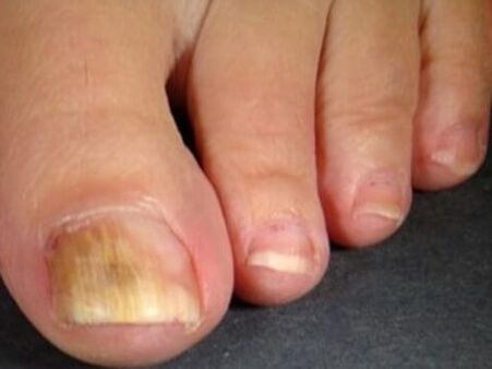 Hongo de uñas