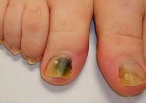 La infección afecta las placas de uñas
