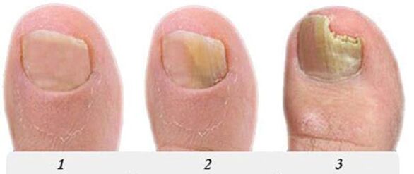 El proceso de desarrollar el hongo en el pulgar