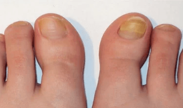 La fase inicial del hongo de las uñas