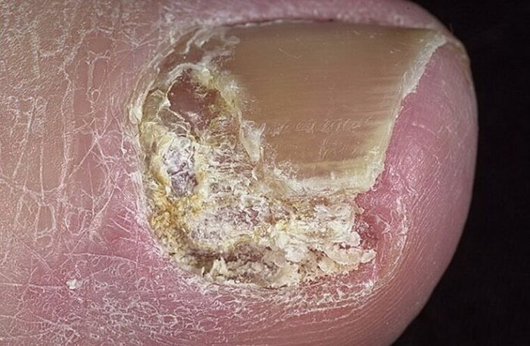 Tipos de onicomicosis