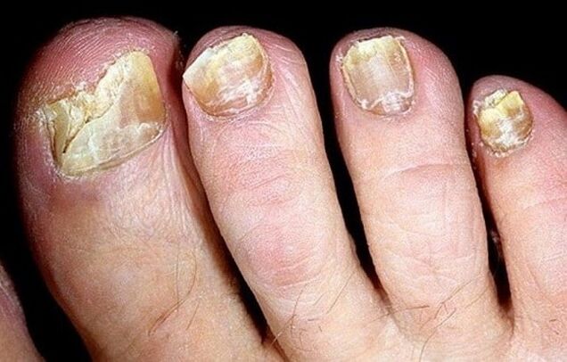 Hongos en las uñas de los pies