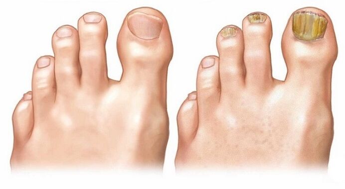 uñas sanas y hongos en las uñas de los pies