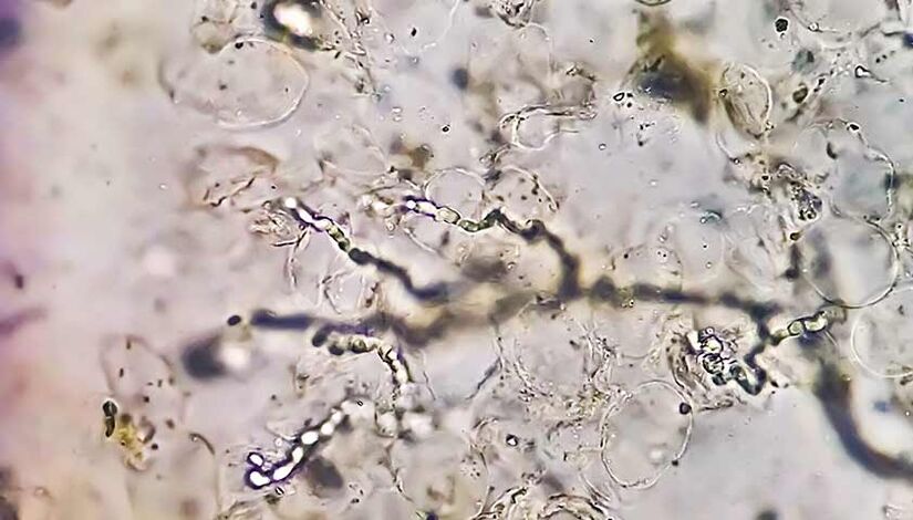 Hongos bajo el microscopio la causa de las micosis en los pies. 